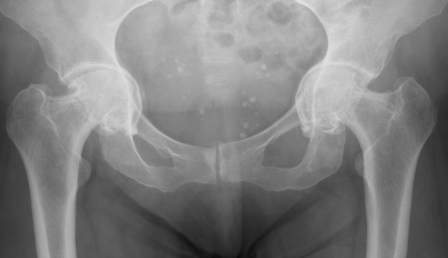 Bilateral Hip Protrusio